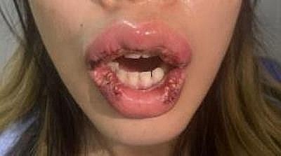 Cắt môi hình trái tim, môi cô gái bị biến dạng