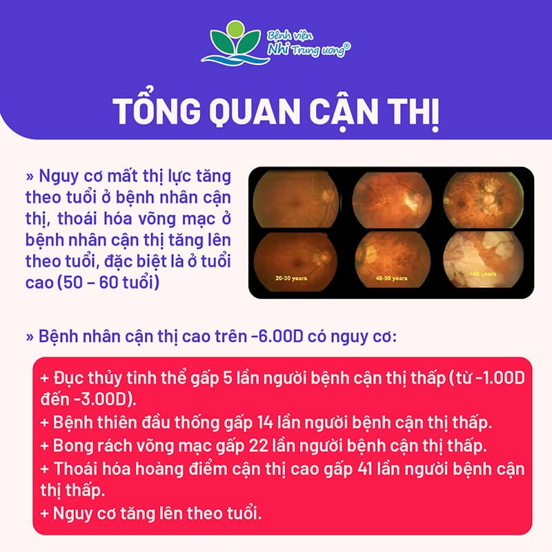 Nguy cơ gia tăng trẻ cận thị sau kỳ nghỉ hè