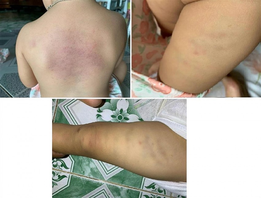 Công an vào cuộc điều tra, làm rõ vụ việc trẻ em bị bạo hành tại một nhà trẻ tư thục