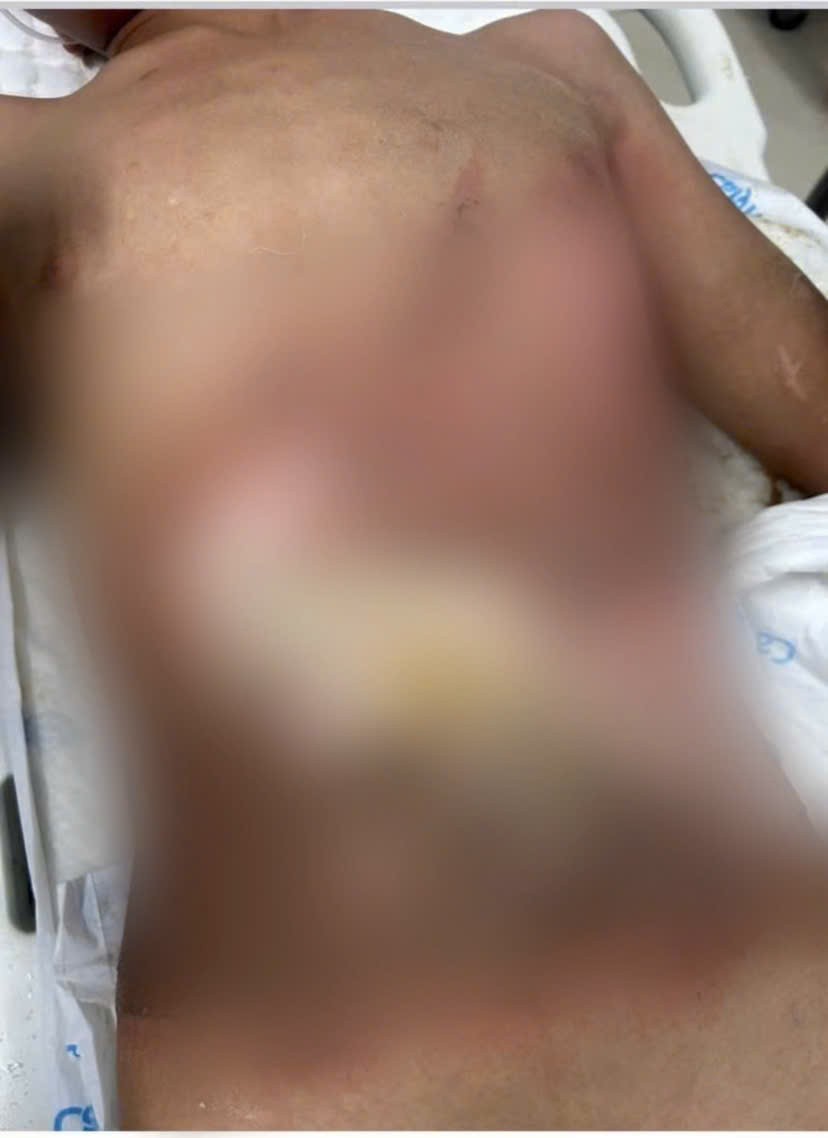 Vết thương gây bỏng nặng vùng ngực cháu bé.