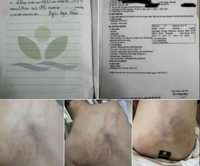 Bộ Y tế thông tin về việc cháu bé 4 tuổi bị bạo hành tại trường mầm non Gia Thụy