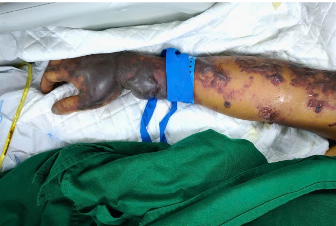 Hiểm họa khôn lường từ vi khuẩn liên cầu lợn khi ăn món tiết canh