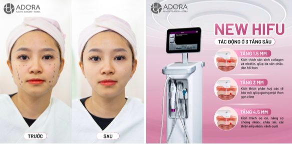 ADORA Plastic Surgery Korea – Địa chỉ làm đẹp chuẩn y khoa, nơi khơi nguồn hành trình thăng hoa nhan sắc của phụ nữ hiện đại