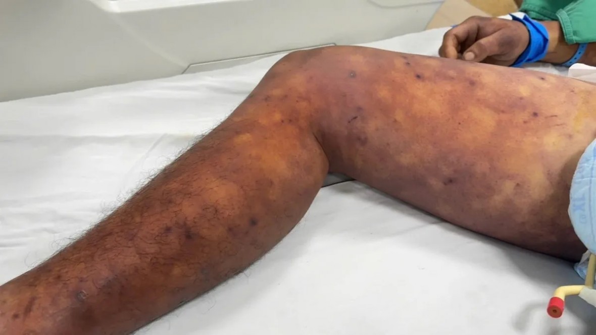 Hà Nội ghi nhận ca đầu tiên tử vong vì mắc liên cầu lợn. (Ảnh minh họa)