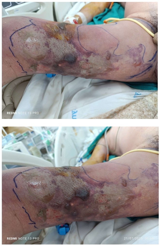 Tổn thương lan nhanh chóng từ một vết đốt nhỏ.