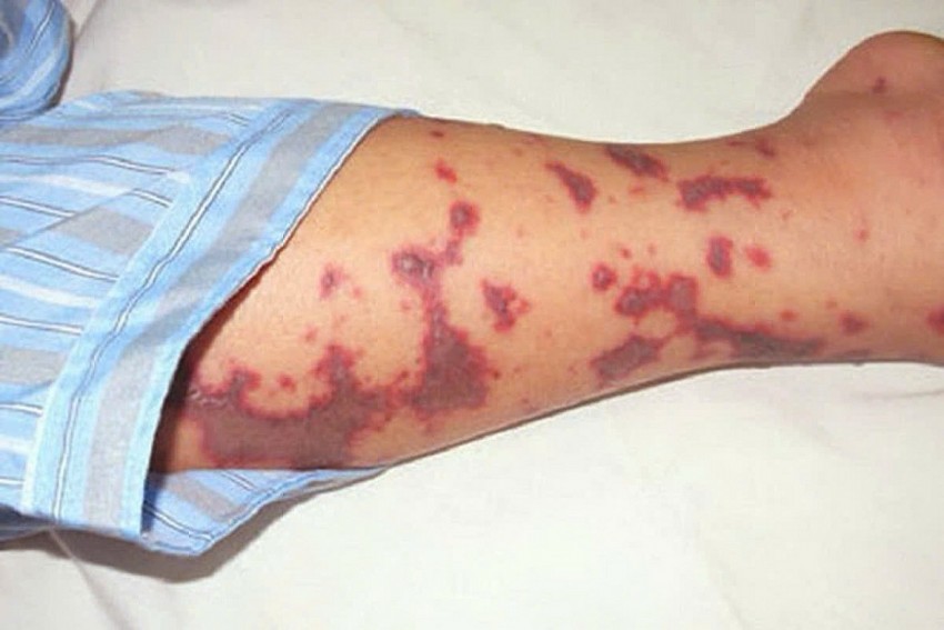 Lần đầu tiên Việt Nam có vaccine phòng bệnh não mô cầu dành cho trẻ dưới 6 tuần tuổi