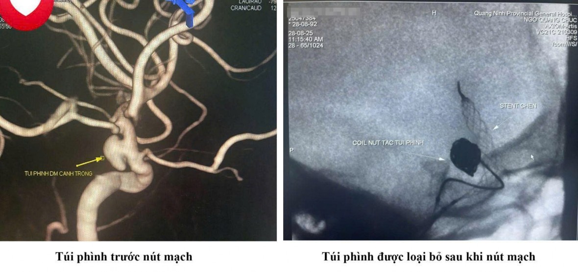 Cứu sống nữ bệnh nhân Quảng Ninh thoát “quả bom nổ chậm” trong não
