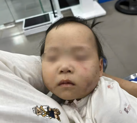 Bé gái bị bầm tím mặt khi được gửi tại cơ sở mầm non tư thục ở Bắc Ninh. Bé gái bị bầm tím mặt khi được gửi tại cơ sở mầm non tư thục ở Bắc Ninh.