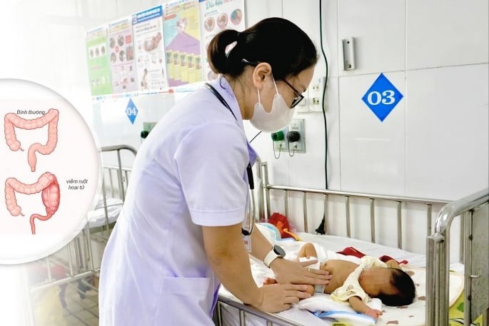 Cứu sống trẻ sinh non bị viêm ruột hoại tử