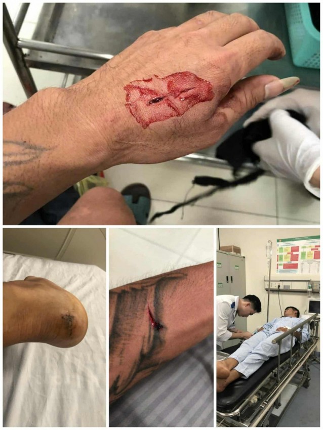 Xuân Mai (Hà Nội): Ba người trong một gia đình bị nhóm người dùng hung khí tấn công, gây thương tích