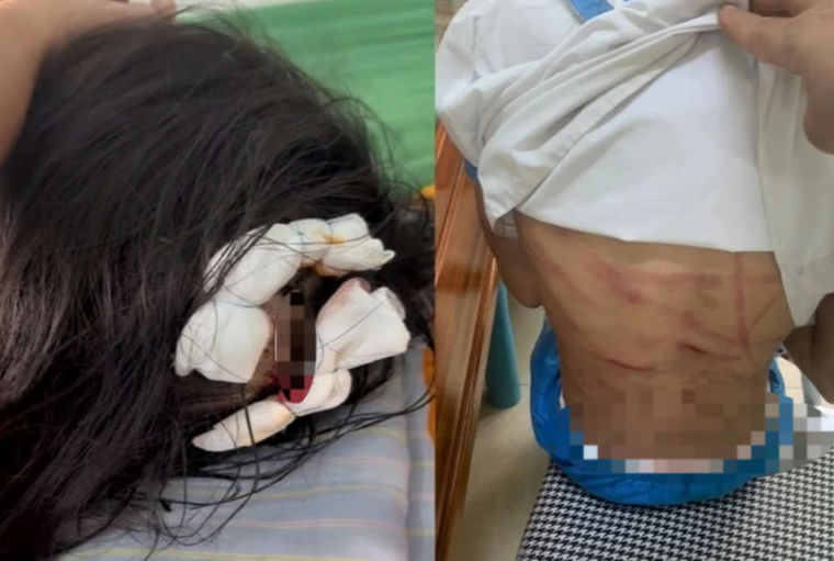 Hình ảnh các vết thương trên người bé L. do cha dượng bạo hành. 