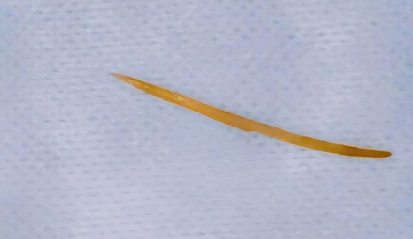 Phẫu thuất lấy xương cá dài 5cm đâm xuyên tá tràng người bệnh