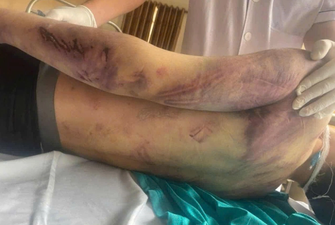 Cơ thể bầm tím của Nam trước khi tử vong. Ảnh: Gia đình cung cấp