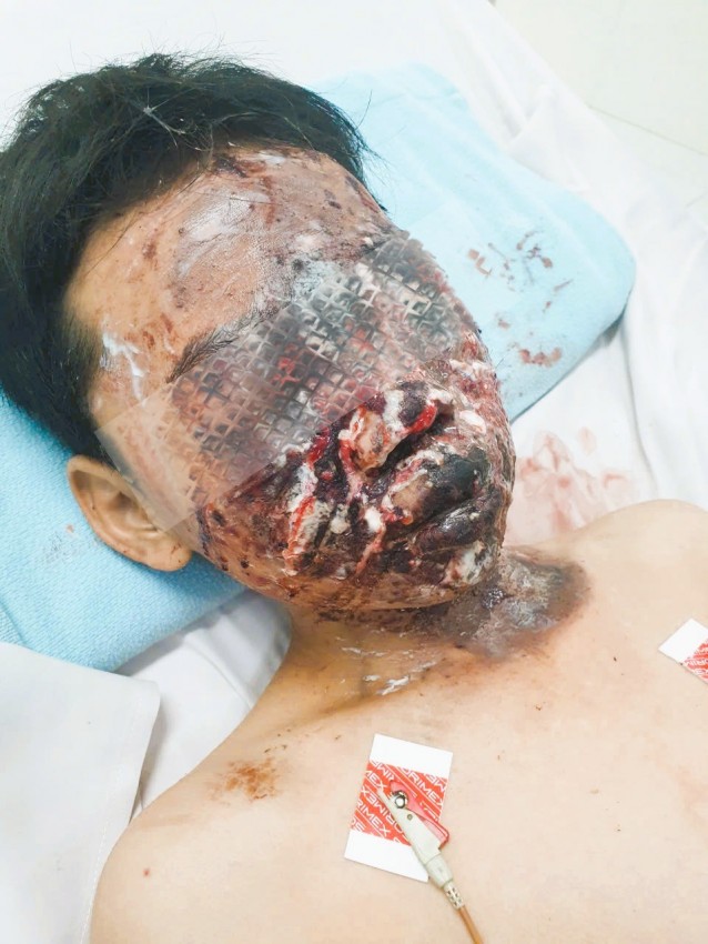 Pháo nổ trôi nổi gây chấn thương nặng cho trẻ em trong dịp lễ, Tết