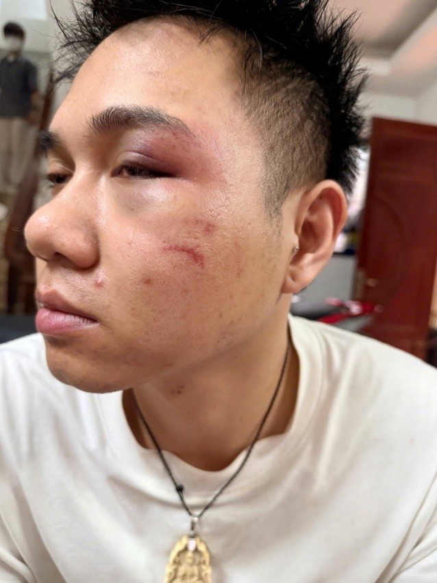 Tài xế xe công nghệ bị hành hung tím mắt vì từ chối chở khách say.