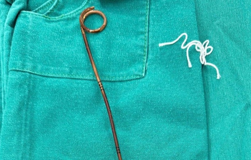 Một bệnh nhân nhập viện do bị “quên” thiết bị y tế trong bụng suốt hai năm