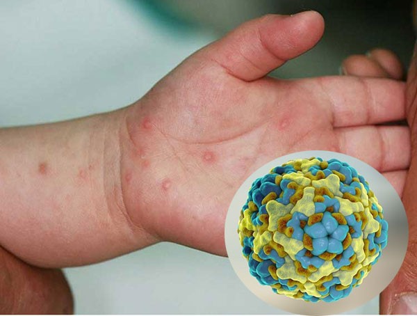 Dịch chân tay miệng gia tăng, đối tượng chủ yếu mắc phải là trẻ nhỏ, hệ miễn dịch chưa đủ đề kháng.