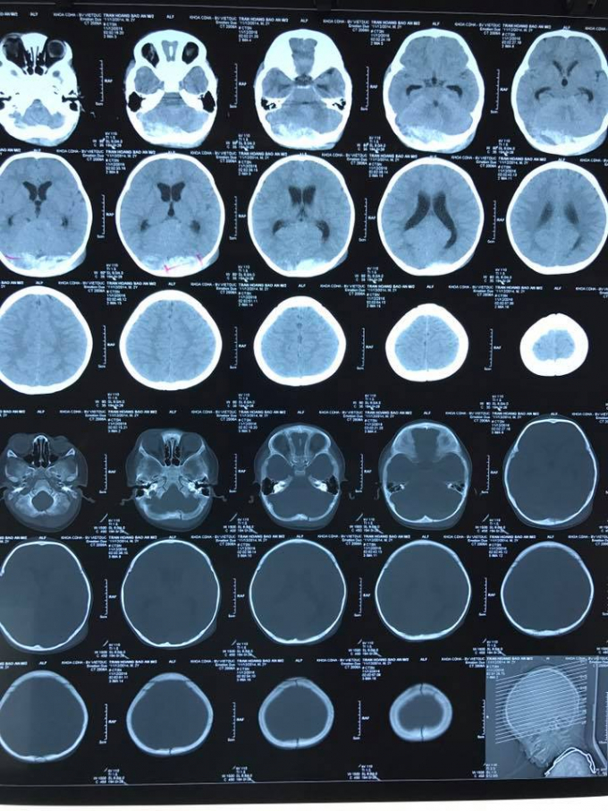 Phim CT-scan trước phẫu thuật&nbsp;cho thấy bệnh nhi c&oacute; m&aacute;u tụ ngo&agrave;i m&agrave;ng cứng chẩm hai b&ecirc;n. Ảnh: BSCC