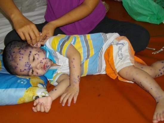 Sau hơn 1 th&aacute;ng khởi ph&aacute;t ổ dịch tại&nbsp;Khu chế xuất T&acirc;n Thuận quận 7 đ&atilde; ghi nhận 30 trường hợp bị thủy đậu. Ảnh: minh họa - ngồn: Infornet