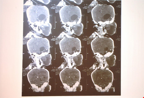 Đ&acirc;y được xem l&agrave; ca bệnh lần đầu ti&ecirc;n ghi nhận tại VN. Ảnh: H&agrave; Phượng