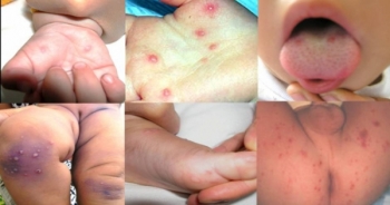 Một em bé tử vong do bệnh tay chân miệng trong ngày mùng 1 Tết