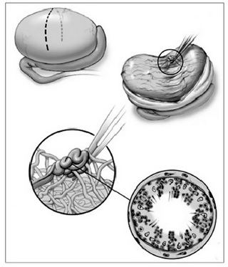 Vi phẫu t&iacute;ch m&ocirc; tinh ho&agrave;n (microTESE) t&igrave;m những nơi c&oacute; ống sinh tinh gi&atilde;n to, trong đ&oacute; thường c&oacute; tinh tr&ugrave;ng (suckhoedoisong.vn    Tin n&ecirc;n đọc   Kỳ lạ 'giếng ti&ecirc;n' x&oacute;a kiếp FA, hiếm muộn?   Bệnh viện Đa khoa quốc tế Vinmec Times City: Những đột ph&aacute; trong điều trị hiếm muộn   Mẹ Lầu: &ldquo;Vua chữa v&ocirc; sinh hiếm muộn&rdquo; tại Mường L&aacute;t - Thanh H&oacute;a   Hy vọng mới cho c&aacute;c cặp vợ chồng hiếm muộn    )