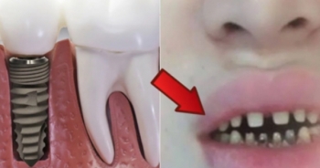 Nguy cơ tiềm ẩn đằng sau trào lưu răng sứ