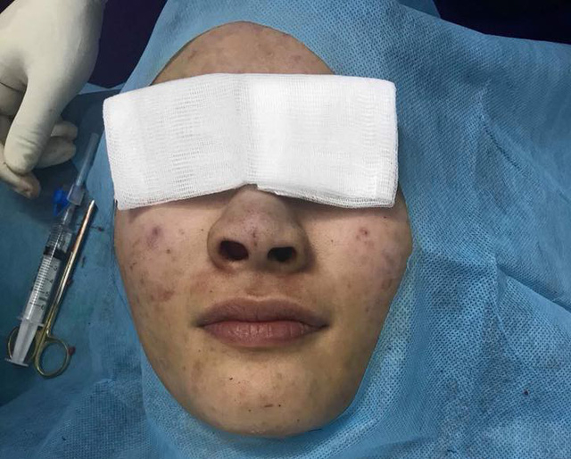 Mũi bệnh nh&acirc;n c&oacute; m&agrave;u xanh do chỉ cấy m&agrave;u xanh tạo ra (Ảnh do BS cung cấp)