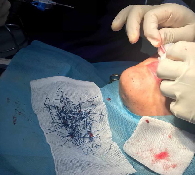 Ước t&iacute;nh, số đoạn chỉ cắt ra n&agrave;y l&agrave; 20-30 đoạn (Ảnh do BS cung cấp)