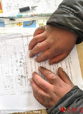 B&agrave;n tay nứt nẻ v&igrave; lạnh của cậu b&eacute; Trung Quốc. Ảnh:&nbsp;Nh&acirc;n d&acirc;n Nhật b&aacute;o.