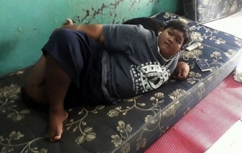 Cậu bé béo nhất thế giới giảm cân thành công