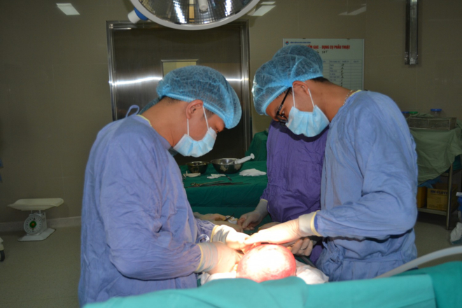 Khối u xơ to như thai 5 th&aacute;ng trong tử cung người phụ nữ