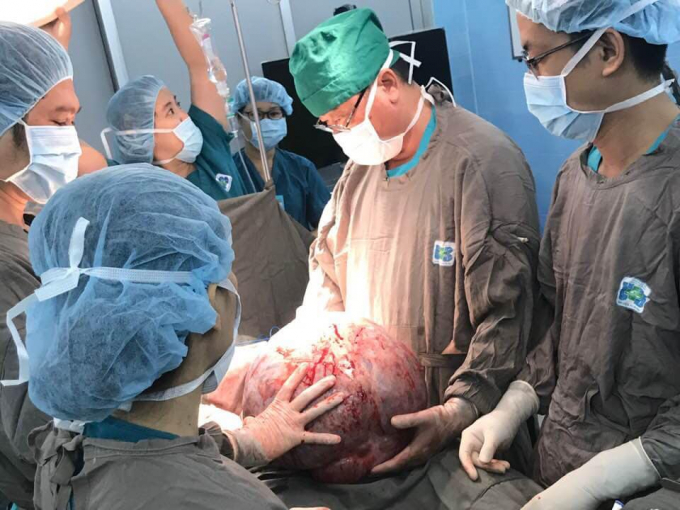 Khối u khổng lồ được lấy ra.