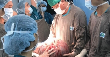 Mang khối u buồng trứng nặng 20kg, người phụ nữ 29 tuổi không thể đi lại