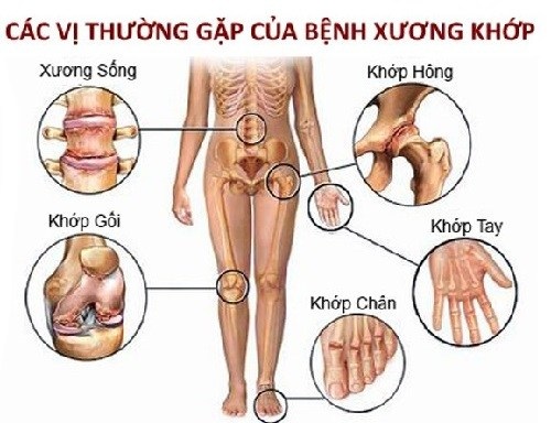 C&aacute;c vị thường gặp của bệnh xương khớp