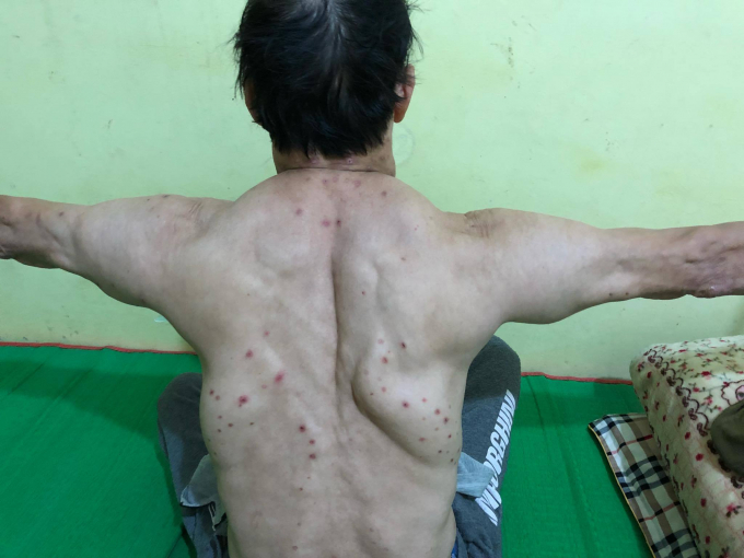 C&aacute;c khối u mọc đối xứng tr&ecirc;n người bệnh nh&acirc;n v&agrave; to l&ecirc;n với tốc độ nhanh ch&oacute;ng.