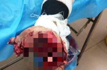 Hãi hùng nam thanh niên dập nát bàn tay vì vừa dùng điện thoại vừa sạc