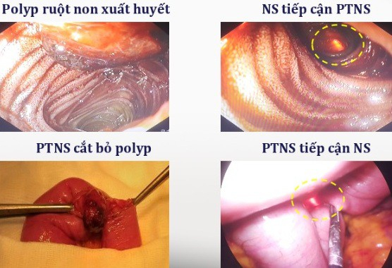 Bệnh nh&acirc;n mất gần 3 l&iacute;t m&aacute;u đường ti&ecirc;u h&oacute;a v&igrave; kh&ocirc;ng t&igrave;m ra vị tr&iacute; chảy m&aacute;u