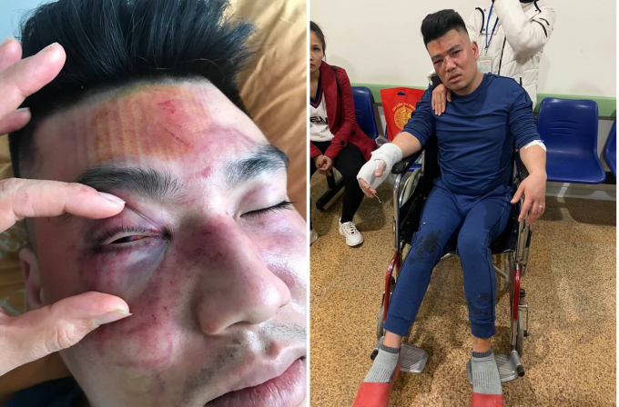 Hiện anh T&uacute; đang được điều trị tại Bệnh viện Đa khoa tỉnh Y&ecirc;n B&aacute;i.