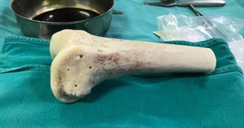 Người phụ nữ 36 tuổi bị khối u ăn mục xương mà không biết