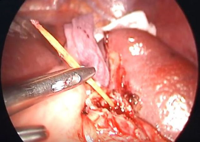 C&acirc;y tăm d&agrave;i 6cm đ&acirc;m thủng l&aacute;ch được gắp ra ngo&agrave;i th&agrave;nh c&ocirc;ng