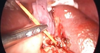 Bị đâm xuyên lách vì ngậm tăm đi ngủ