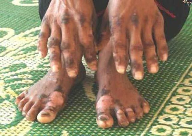 &ldquo;Bệnh lạ&rdquo; ở Quảng Ng&atilde;i kh&ocirc;ng lạ như đồn đại