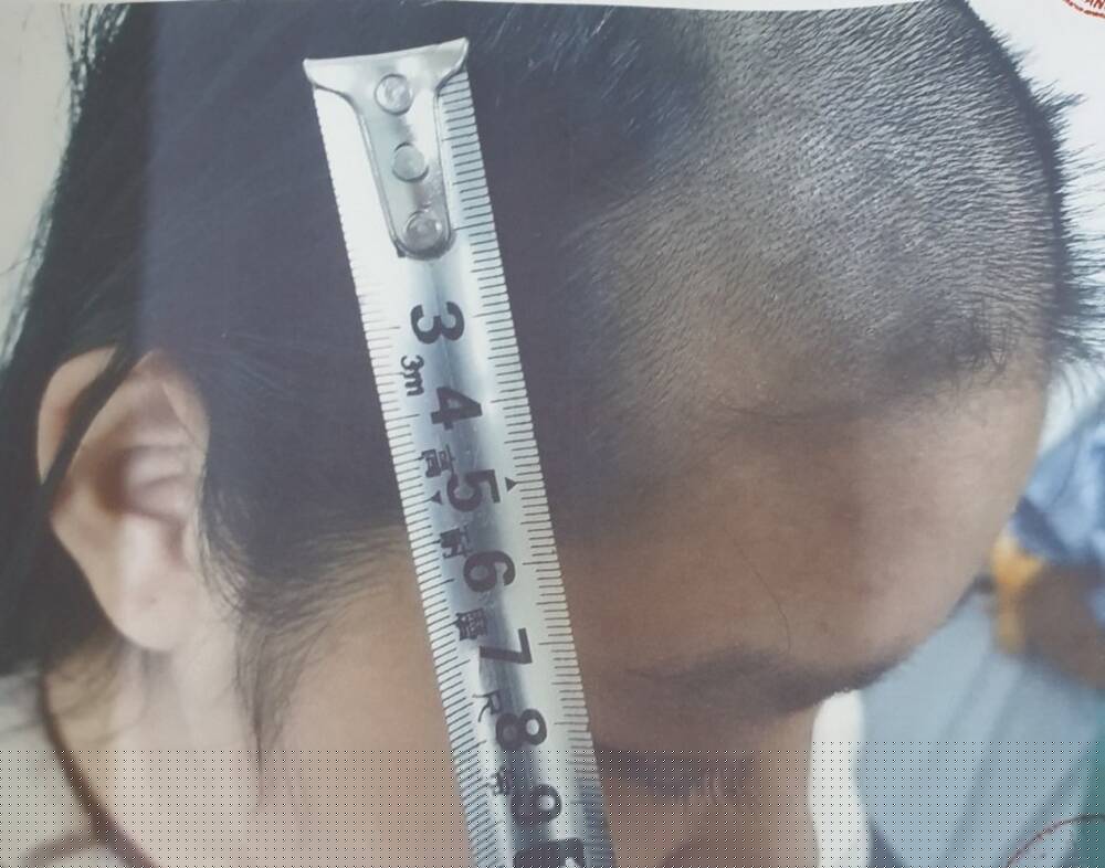 Cháu H bị chấn thương vùng đầu.