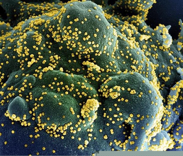 Một tế bào (xanh dương/xanh lục) bị nhiễm nặng các hạt virus SARS-CoV-2 (màu vàng), được phân lập từ mẫu của bệnh nhân COVID-19. (Ảnh: AFP/TTXVN)
