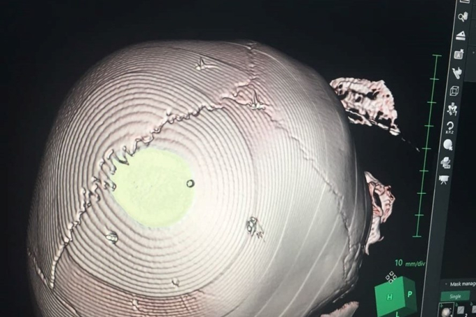 H&igrave;nh ảnh chụp vết thương sọ n&atilde;o của b&eacute; 3 tuổi. Ảnh: BSCC