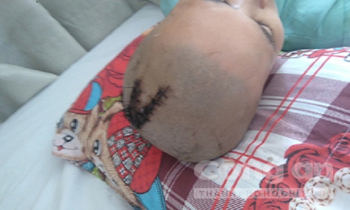 Chị Phương bị chồng ch&eacute;m 2 nh&aacute;t v&agrave;o đầu.