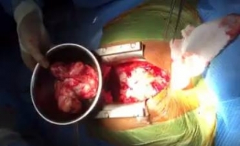 Phẫu thuật bóc thành công khối u 700gr trong lồng ngực gây chèn ép tim