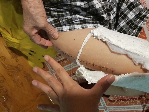 Hiện ch&aacute;u Ki&ecirc;n vẫn chưa thể đi lại b&igrave;nh thường v&agrave; phải nghỉ học ở nh&agrave; hơn hai th&aacute;ng nay để điều trị (Ảnh: Ch&iacute; Dũng).