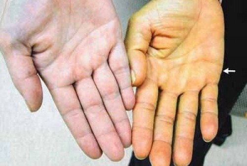 Khi đến, ở trong v&ugrave;ng dịch tại c&aacute;c nước đang c&oacute; dịch cần chủ động thực hiện c&aacute;c biện ph&aacute;p xua muỗi v&agrave; ph&ograve;ng ph&ograve;ng muỗi đốt. Ảnh: minh họa/Nguồn: suckhoedoisong.vn